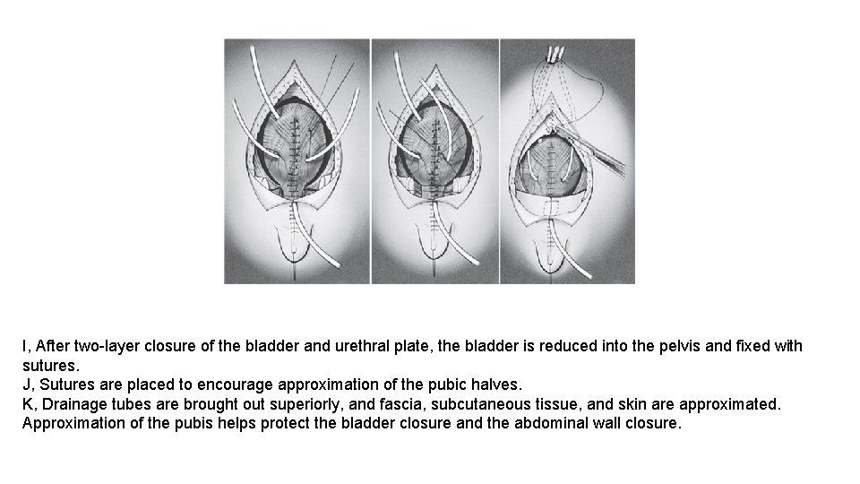 I, After two-layer closure of the bladder and urethral plate, the bladder is reduced