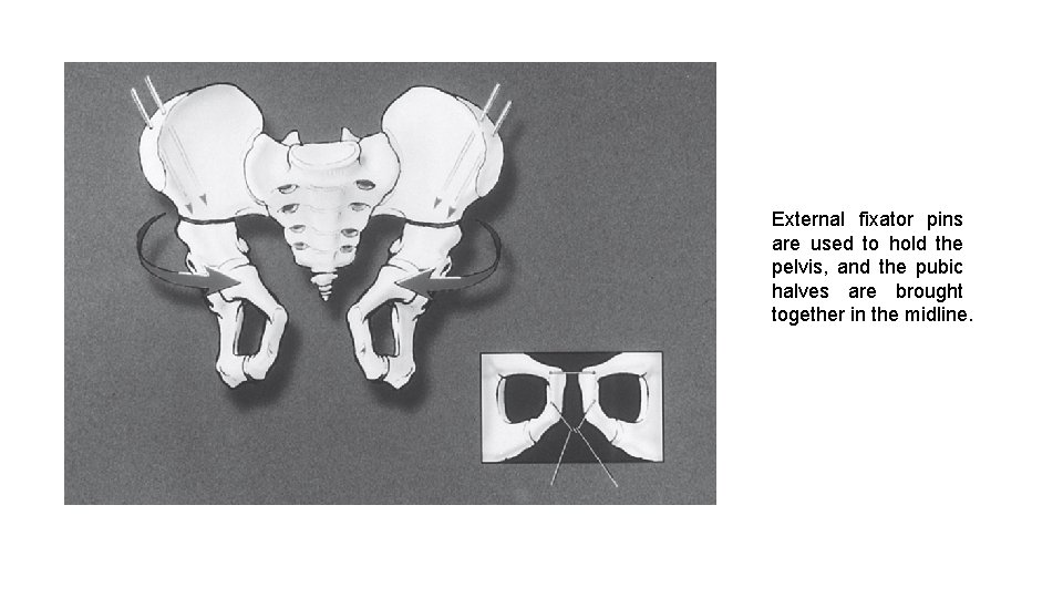 External fixator pins are used to hold the pelvis, and the pubic halves are