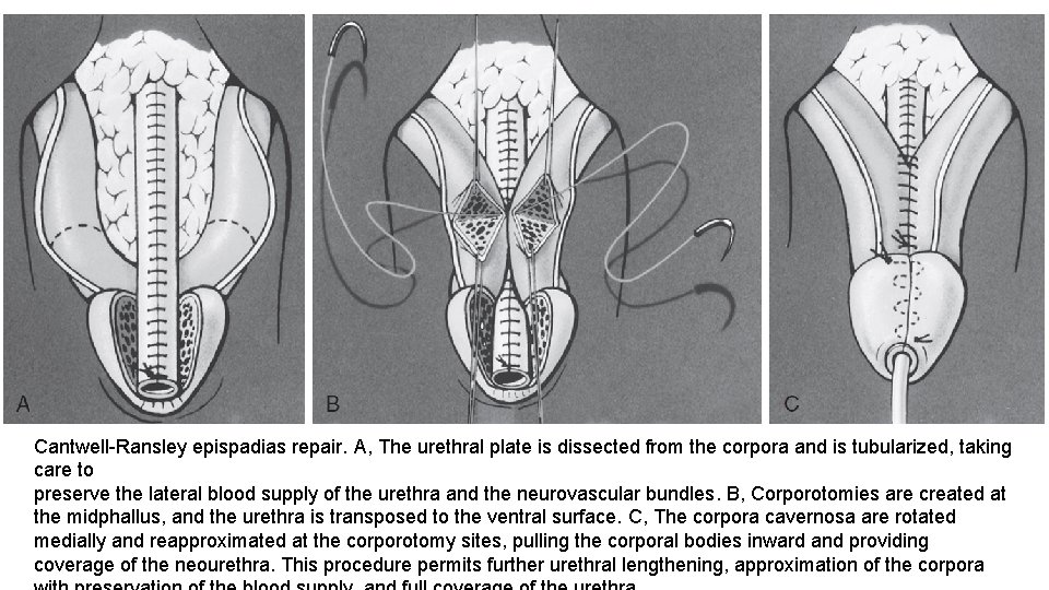 Cantwell-Ransley epispadias repair. A, The urethral plate is dissected from the corpora and is