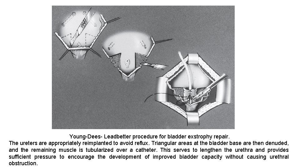 Young-Dees- Leadbetter procedure for bladder exstrophy repair. The ureters are appropriately reimplanted to avoid