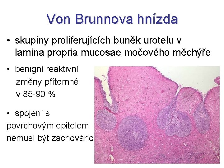 Von Brunnova hnízda • skupiny proliferujících buněk urotelu v lamina propria mucosae močového měchýře