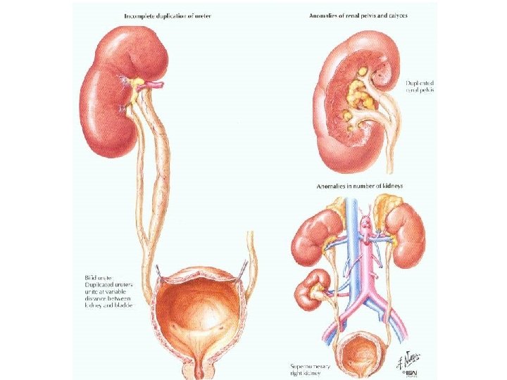 Vývojové vady močového systému 