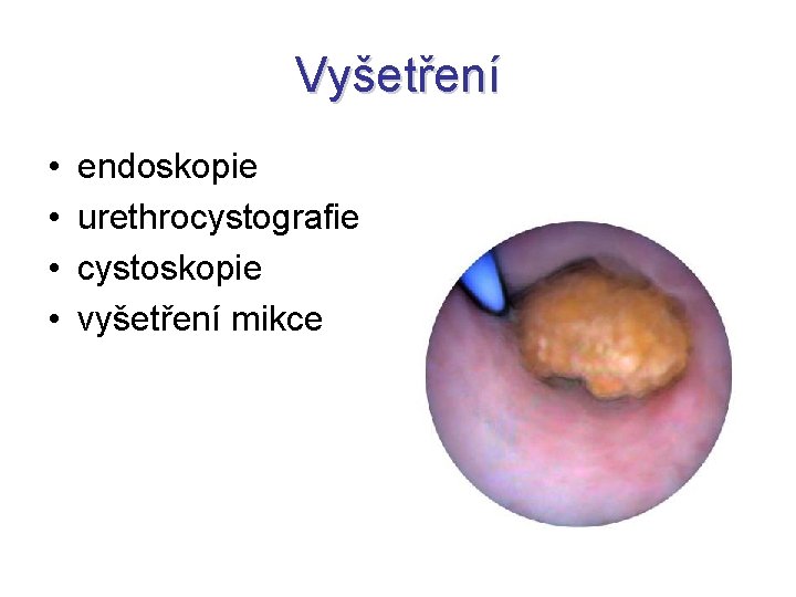 Vyšetření • • endoskopie urethrocystografie cystoskopie vyšetření mikce 