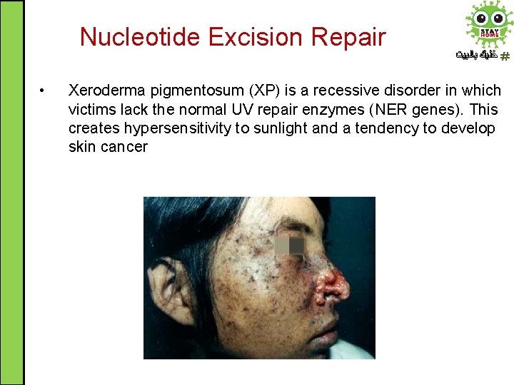 Nucleotide Excision Repair • ﺧﻠﻴﻚ ﺑﺎﻟﺒﻴﺖ Xeroderma pigmentosum (XP) is a recessive disorder in