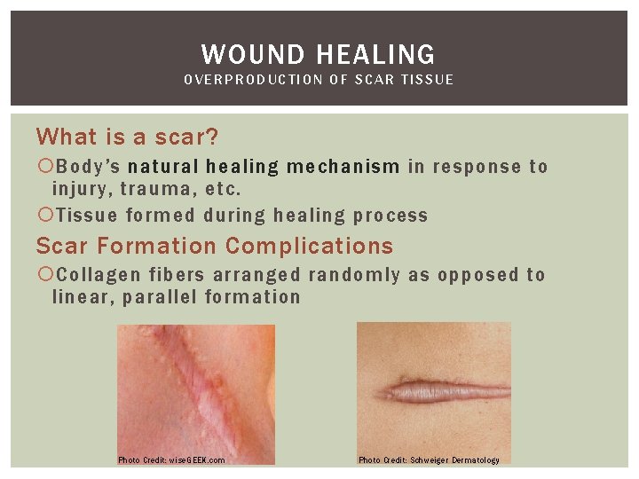 WOUND HEALING OVERPRODUCTION OF SCAR TISSUE What is a scar? Body’s natural healing mechanism