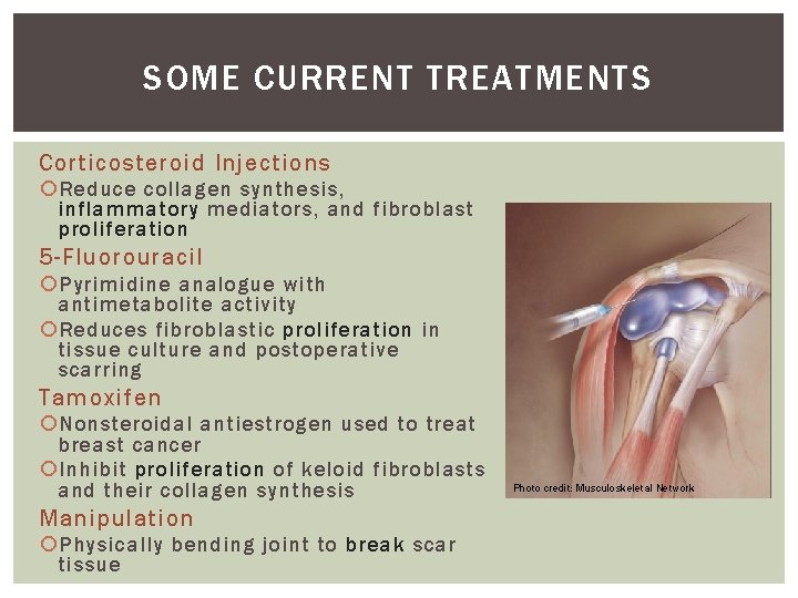 SOME CURRENT TREATMENTS Corticosteroid Injections Reduce collagen synthesis, inflammatory mediators, and fibroblast proliferation 5