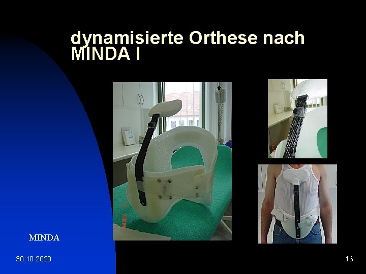 dynamisierte Orthese nach MINDA I MINDA 30. 10. 2020 16 