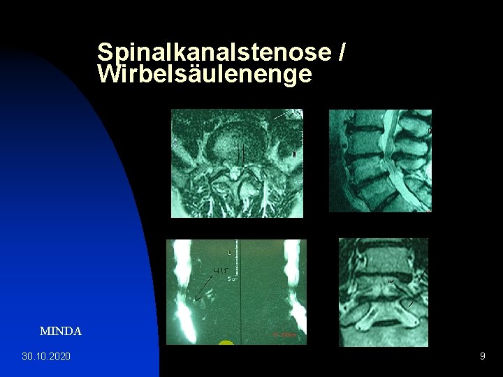 Spinalkanalstenose / Wirbelsäulenenge MINDA 30. 10. 2020 9 