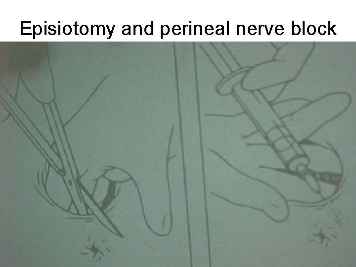 Episiotomy and perineal nerve block Episiotomy and perineal nerve block