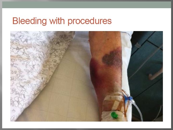 Case Study � Commenced Ibrutinib Feb 2015 � 50% Reduction in tonsillar node in