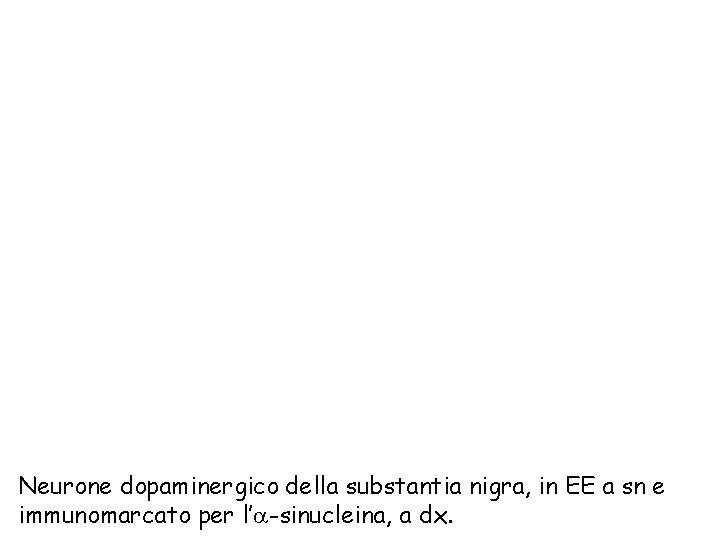 Neurone dopaminergico della substantia nigra, in EE a sn e immunomarcato per l’a-sinucleina, a