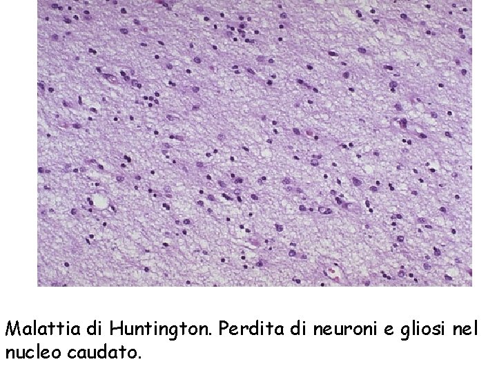 Malattia di Huntington. Perdita di neuroni e gliosi nel nucleo caudato. 