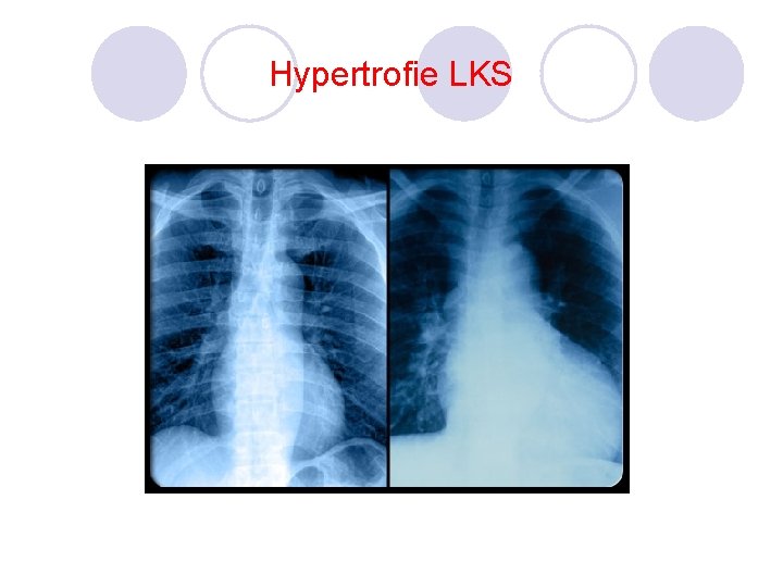 Hypertrofie LKS 