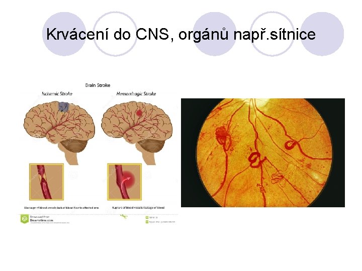 Krvácení do CNS, orgánů např. sítnice 