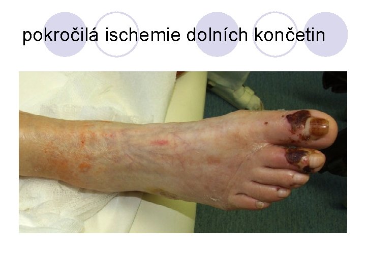 pokročilá ischemie dolních končetin 