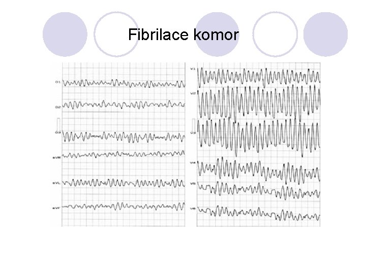 Fibrilace komor 