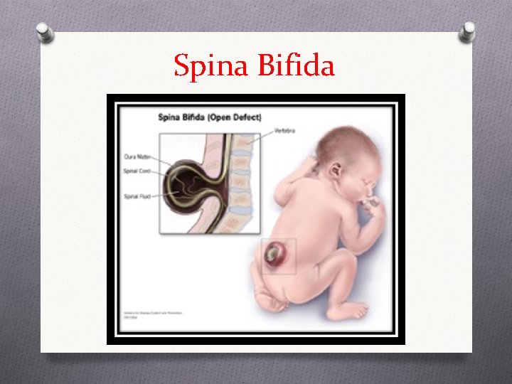 Spina Bifida 