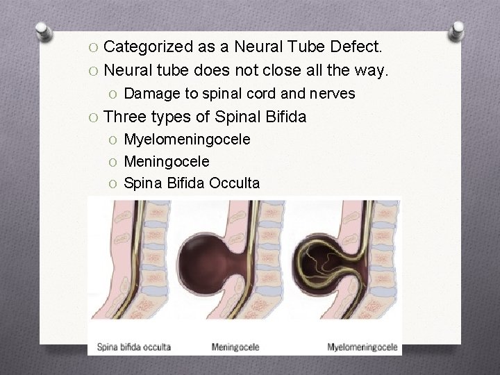 O Categorized as a Neural Tube Defect. O Neural tube does not close all