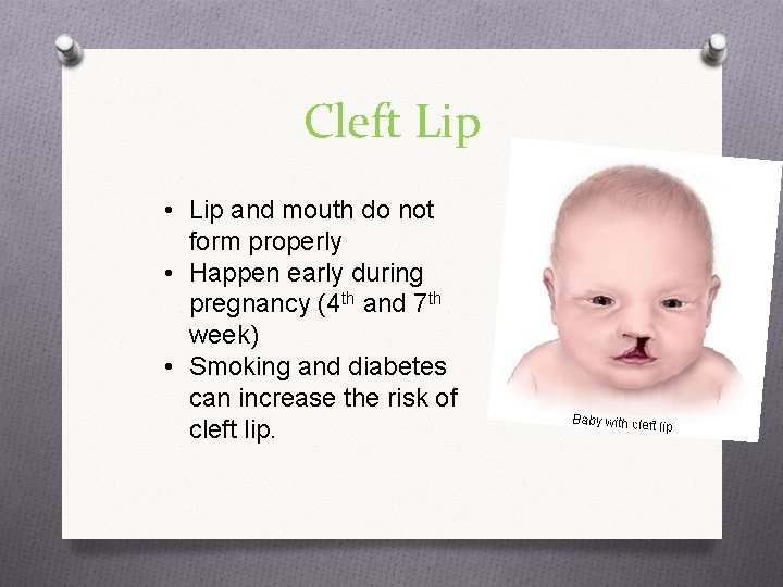 Cleft Lip • Lip and mouth do not form properly • Happen early during