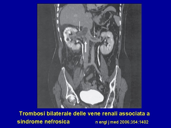 Trombosi bilaterale delle vene renali associata a sindrome nefrosica n engl j med 2006;