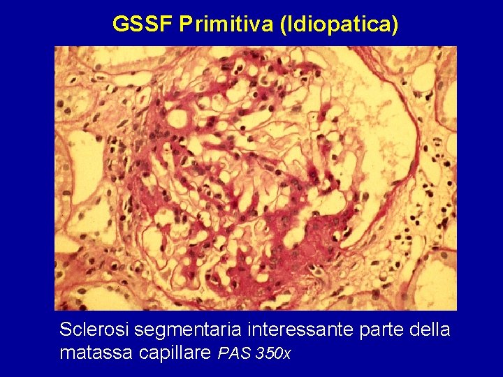 GSSF Primitiva (Idiopatica) Sclerosi segmentaria interessante parte della matassa capillare PAS 350 x 