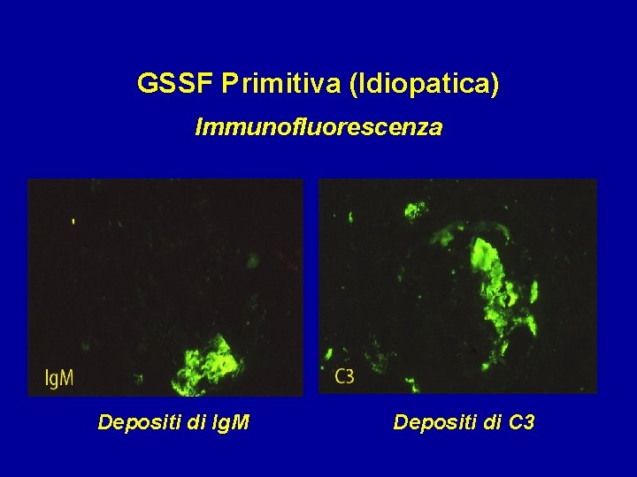GSSF Primitiva (Idiopatica) Immunofluorescenza Depositi di Ig. M Depositi di C 3 
