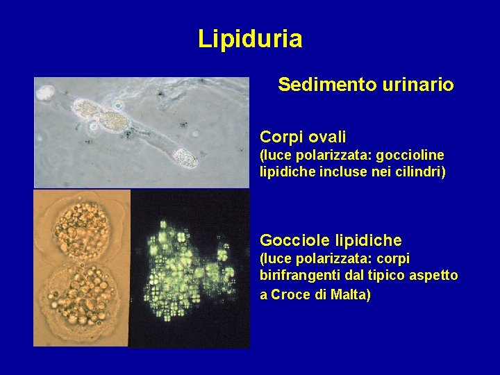 Lipiduria Sedimento urinario Corpi ovali (luce polarizzata: goccioline lipidiche incluse nei cilindri) Gocciole lipidiche