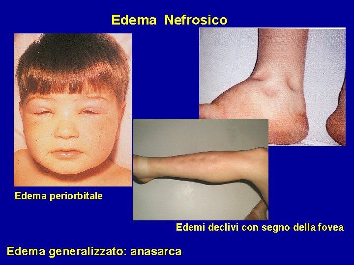 Edema Nefrosico Edema periorbitale Edemi declivi con segno della fovea Edema generalizzato: anasarca 