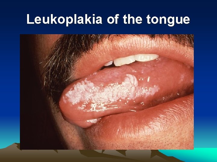 Leukoplakia of the tongue 