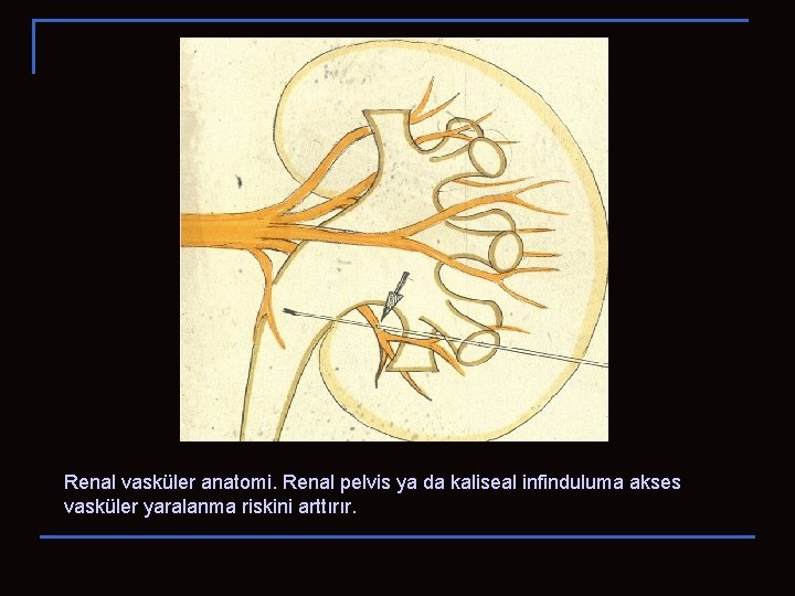 Renal vasküler anatomi. Renal pelvis ya da kaliseal infinduluma akses vasküler yaralanma riskini arttırır.