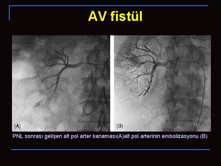 AV fistül PNL sonrası gelişen alt pol arter kanaması(A)alt pol arterinin embolizasyonu (B) 