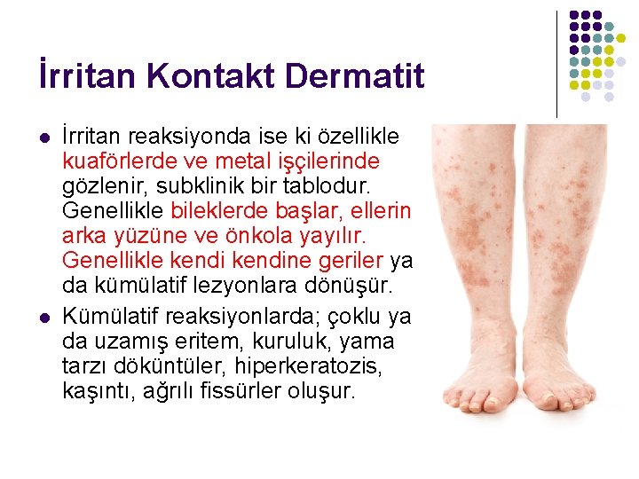 İrritan Kontakt Dermatit l l İrritan reaksiyonda ise ki özellikle kuaförlerde ve metal işçilerinde