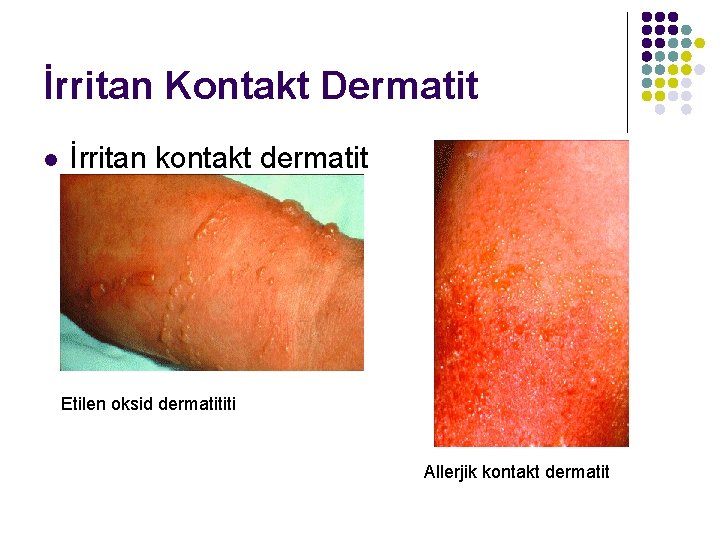 İrritan Kontakt Dermatit l İrritan kontakt dermatit Etilen oksid dermatititi Allerjik kontakt dermatit 