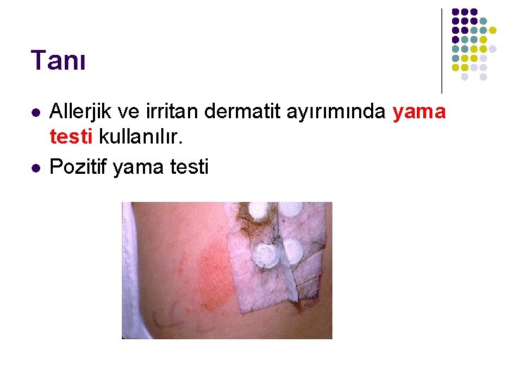 Tanı l l Allerjik ve irritan dermatit ayırımında yama testi kullanılır. Pozitif yama testi