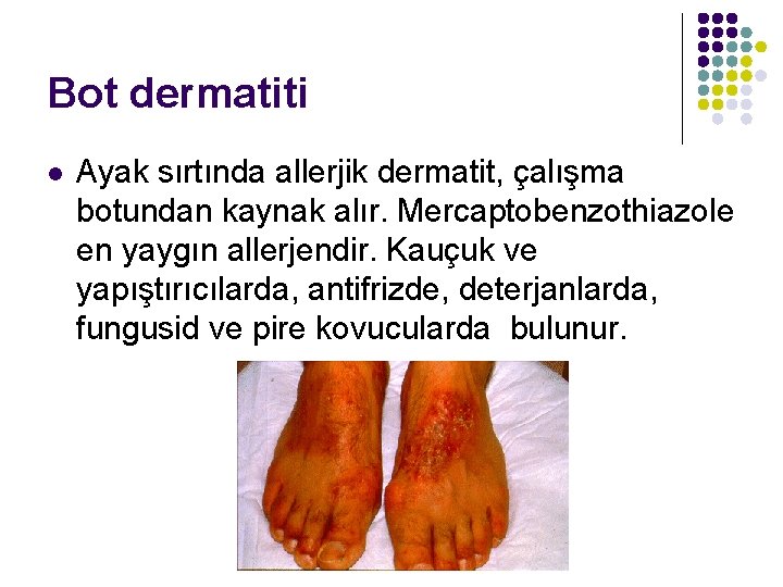 Bot dermatiti l Ayak sırtında allerjik dermatit, çalışma botundan kaynak alır. Mercaptobenzothiazole en yaygın