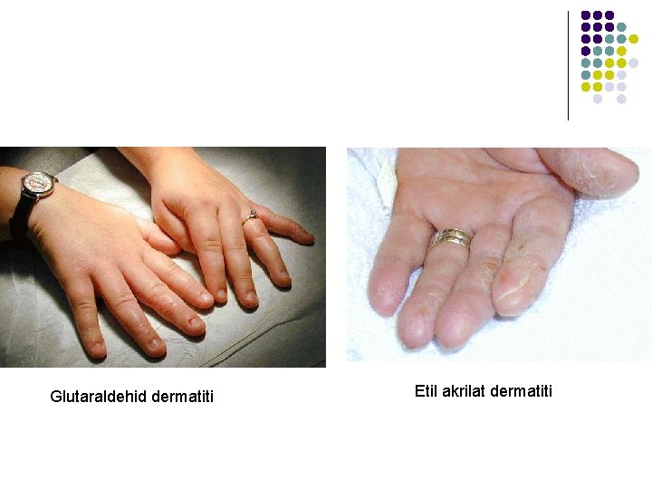 Glutaraldehid dermatiti Etil akrilat dermatiti 