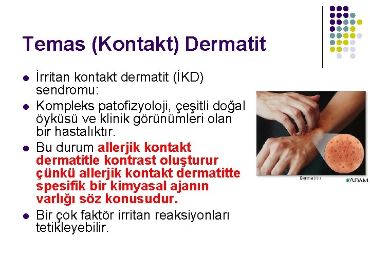 Temas (Kontakt) Dermatit l l İrritan kontakt dermatit (İKD) sendromu: Kompleks patofizyoloji, çeşitli doğal