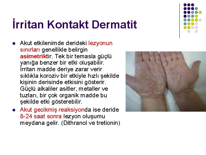 İrritan Kontakt Dermatit l l Akut etkilenimde derideki lezyonun sınırları genellikle belirgin asimetriktir. Tek