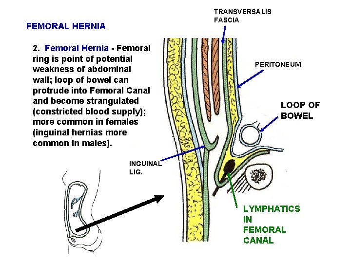 TRANSVERSALIS FASCIA FEMORAL HERNIA 2. Femoral Hernia - Femoral ring is point of potential