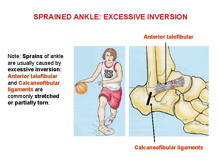 SPRAINED ANKLE: EXCESSIVE INVERSION Anterior talofibular Note: Sprains of ankle are usually caused by