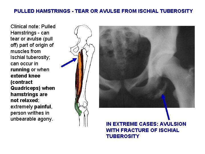 PULLED HAMSTRINGS - TEAR OR AVULSE FROM ISCHIAL TUBEROSITY Clinical note: Pulled Hamstrings -