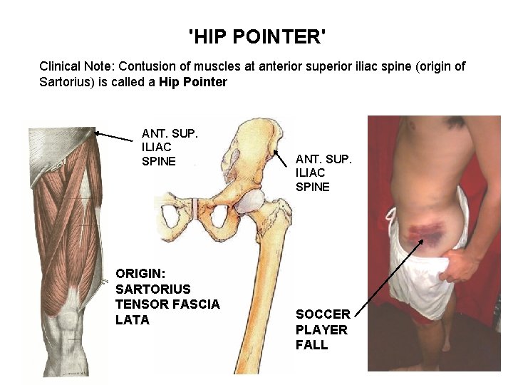 'HIP POINTER' Clinical Note: Contusion of muscles at anterior superior iliac spine (origin of