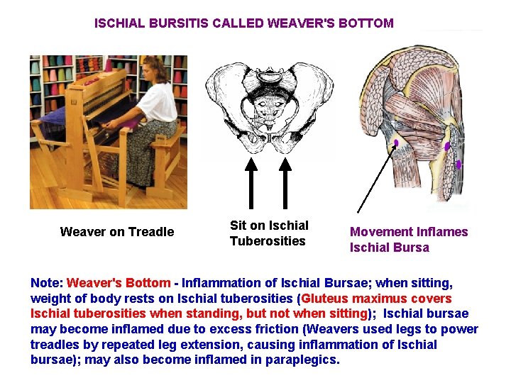 ISCHIAL BURSITIS CALLED WEAVER'S BOTTOM Weaver on Treadle Sit on Ischial Tuberosities Movement Inflames