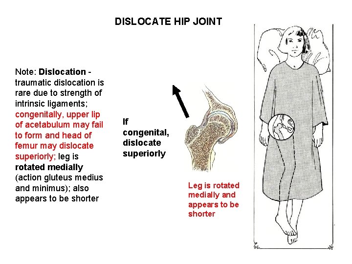DISLOCATE HIP JOINT Note: Dislocation traumatic dislocation is rare due to strength of intrinsic