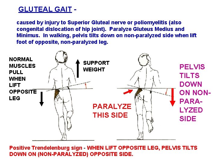 GLUTEAL GAIT caused by injury to Superior Gluteal nerve or poliomyelitis (also congenital dislocation