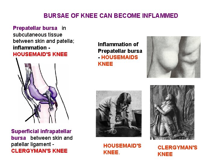 BURSAE OF KNEE CAN BECOME INFLAMMED Prepatellar bursa in subcutaneous tissue between skin and