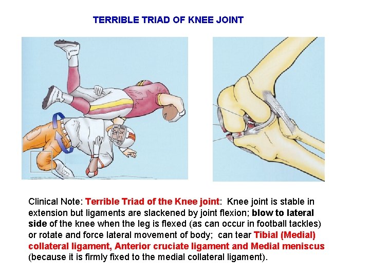 TERRIBLE TRIAD OF KNEE JOINT Clinical Note: Terrible Triad of the Knee joint: Knee