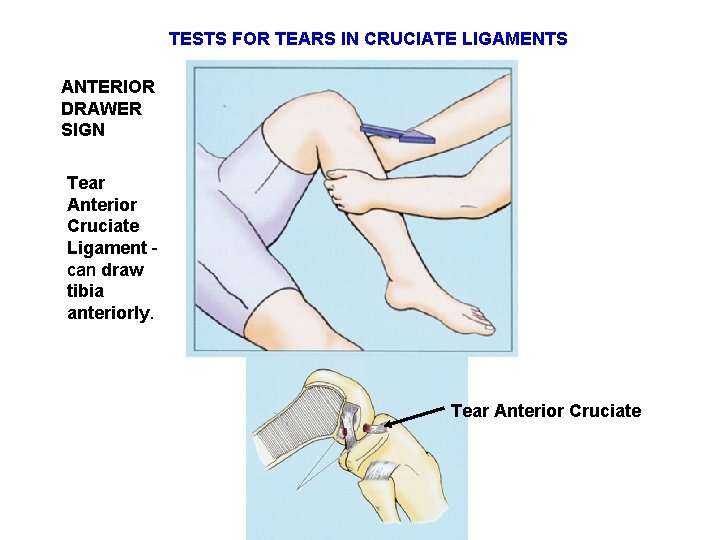 TESTS FOR TEARS IN CRUCIATE LIGAMENTS ANTERIOR DRAWER SIGN Tear Anterior Cruciate Ligament can