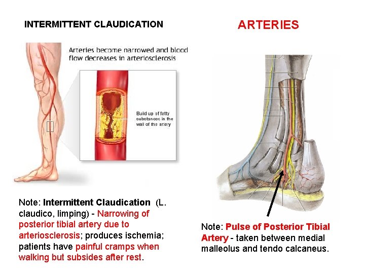 INTERMITTENT CLAUDICATION Note: Intermittent Claudication (L. claudico, limping) - Narrowing of posterior tibial artery