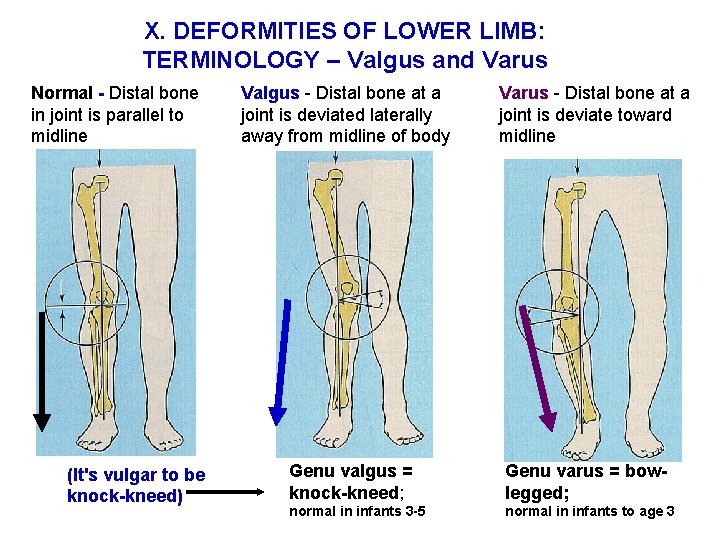 X. DEFORMITIES OF LOWER LIMB: TERMINOLOGY – Valgus and Varus Normal - Distal bone